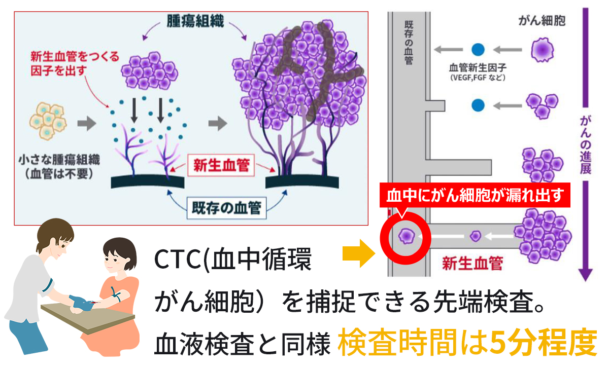 マイクロＣＴＣ検査はCTCを補捉できる先端検査