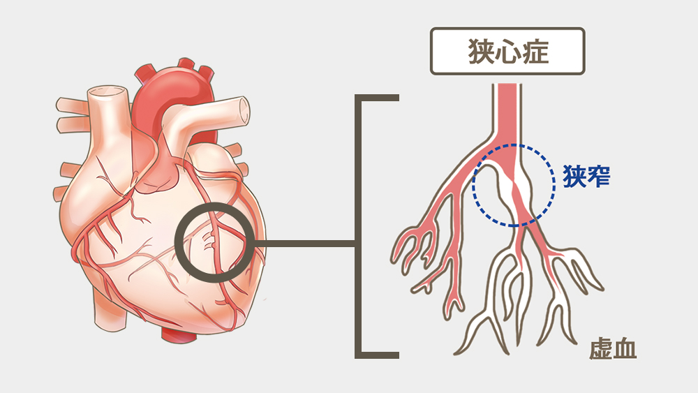 狭心症