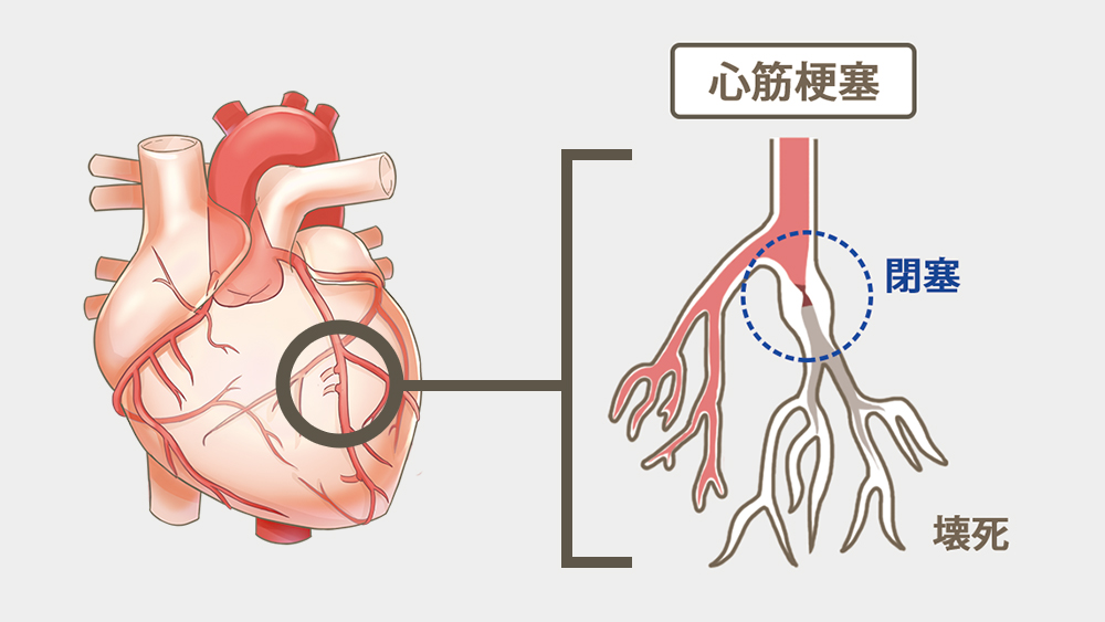 心筋梗塞