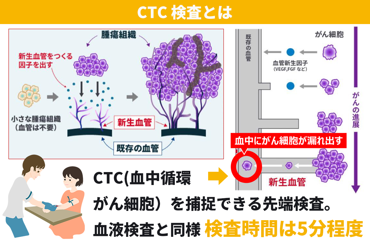 マイクロＣＴＣ検査はCTCを補捉できる先端検査